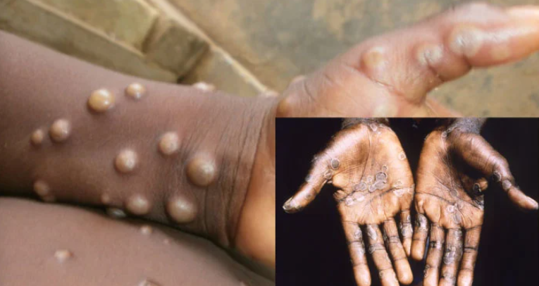 Mpox Virus